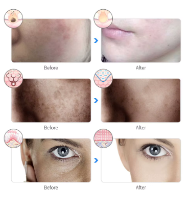 Rechargeable Facial LED Mask